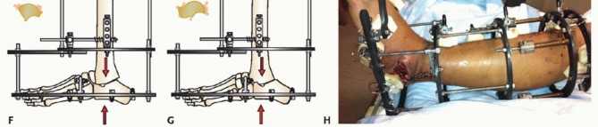 Illustration 13 for Beyond Amputation: Circular Fixation for Infection of the Talus