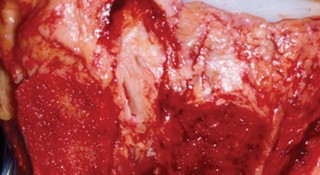 Illustration 25 for Precision Soft Tissue Balancing in Revision: Avoid TKA Pitfalls