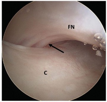Illustration 29 for Beyond Knee Surg: Hip Arthroscopy for Sports Injuries
