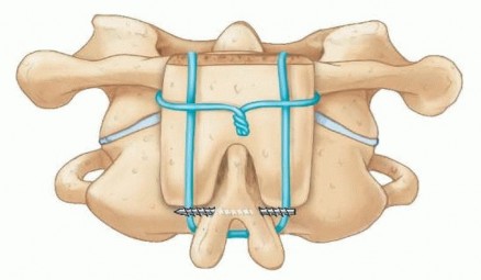 Illustration 30 for Addressing Cervical Spine Instability with Posterior Arthrodesis
