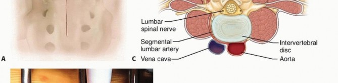 Illustration 12 for Mastering High-Grade Spondylolisthesis: Posterolateral and Interbody Fusion