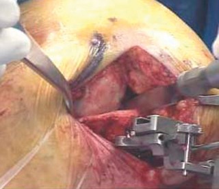 صورة طبية: تقويم مفصل الركبة أحادي الحجرة دليل شامل للمرضى في صنعاء