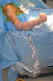 Illustration 8 for Capsular Releases for Loss of Motion: Restore Your Shoulder