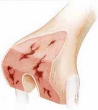 Illustration of bone loss distal - Dr. Mohammed Hutaif
