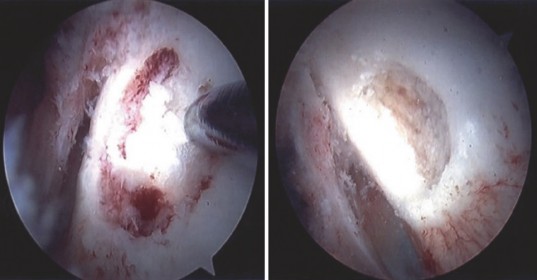 Illustration 15 for Solving Persistent Hip Pain: Arthroscopic Osteoid Osteoma Lesion Excision