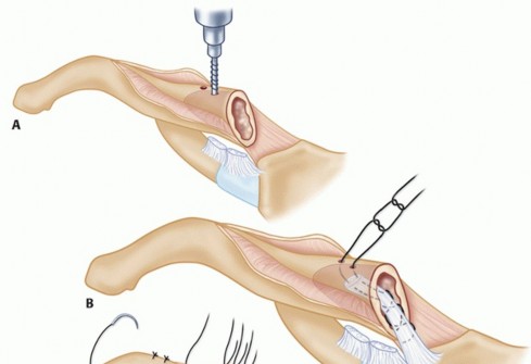 Illustration 27 for Optimizing SC Dislocation Repair After Medial Clavicle Resection