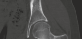 Solving Persistent Hip Pain: Arthroscopic Osteoid Osteoma Lesion Excision