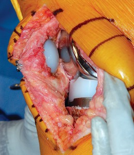 Illustration 63 for Mastering Gap Balancing in Revision TKA: Avoid Common Pitfalls