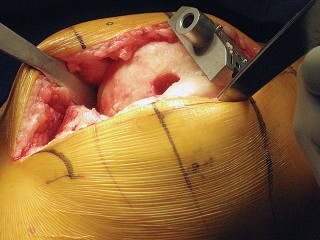 Illustration 14 for Posterior Stabilized Technique: Essential Insights for TKA Success