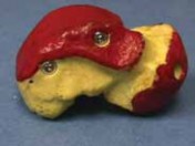 Illustration 25 for Talar Neck Fracture Treatment: Optimizing Recovery with ORIF