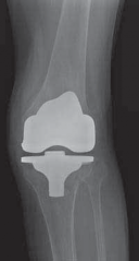 Illustration of arthroplasty with tibial bone - Dr. Mohammed Hutaif