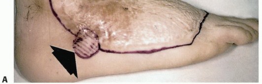 Illustration 3 for Below-Knee Amputation: Maximize Your Below-Knee Recovery & Function