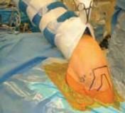 Illustration 13 for Regain Stability: Anterior Shoulder Instability Arthroscopic Fix