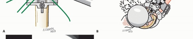 Illustration 26 for Hemiarthroplasty for Proximal: Effective Treatment for Fractures