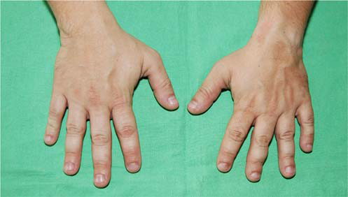 Illustration 4 for Understanding Multiple Epiphyseal Dysplasia: Orthopedic Cases