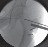 Illustration 20 for Increased Femoral Anteversion: A Proximal Femoral Rotational Osteotomy