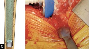 Illustration 29 for Mastering Cementing Technique Femur: A Step-by-Step Guide