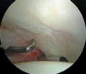 Illustration 24 for Solving Hip Soft Tissue Pathology with Advanced Arthroscopy