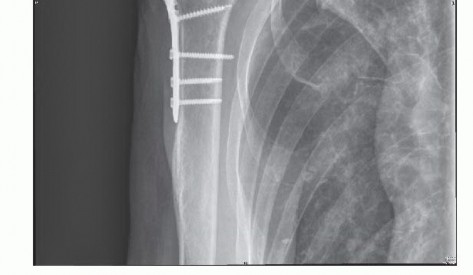 Illustration 4 for Stiff Shoulder? Discover Arthroscopic Capsular Release Solutions