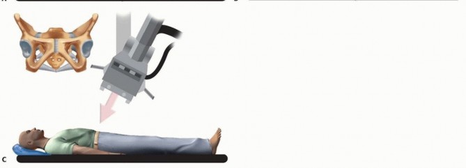 Illustration 4 for Emergency Fixation of the Pelvis: Control Bleeding & Restore Stability