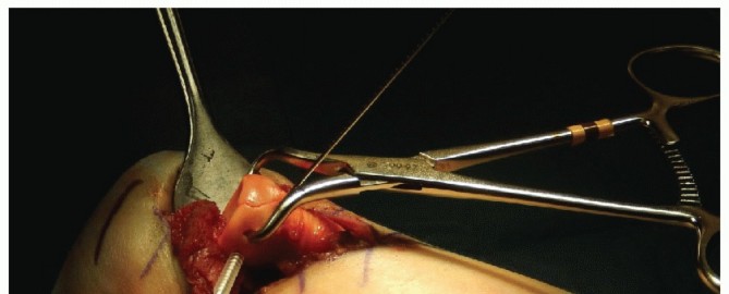 Illustration 41 for Radial Head & Neck Fractures: Mastering ORIF for Best Results
