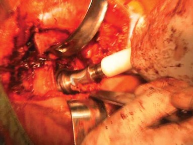 Illustration 14 for Unlock Movement: Arthroplasty for Bony Ankylosis Solutions