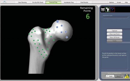 Illustration 17 for Robotics in Total Hip Arthroplasty: A New Era of Precision