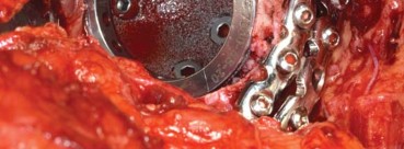 Illustration 56 for Management of Periprosthetic Fractures: An Expert Surgical Guide