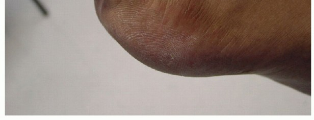 Illustration 37 for Restore Your Foot: Surgical Treatment for Hallux MP Joint Turf Toe