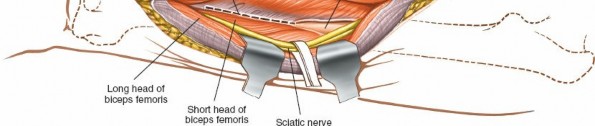 Illustration 47 for Optimal Femoral Approaches: Mastering the Lateral Intermuscular Septum
