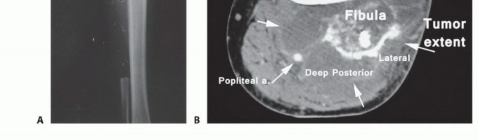 Illustration 8 for Mastering Above-Knee Amputation: Essential Surgical Insights
