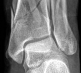 Illustration 2 for Decoding Pilon Fractures: Anterolateral and Medial Fragments Revealed