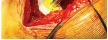 Illustration 27 for Cemented Acetabular Component: Achieving Optimal THA Stability