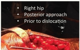 Illustration 6 for Extensively Porouscoated Stems: Proven Success & Superior Fixation