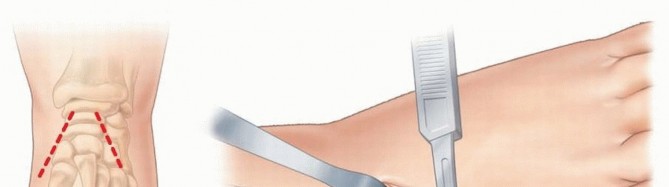 Illustration 10 for Why Anterior Tibialis Muscle Transfer Fixes Clubfoot