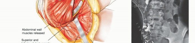 Illustration 26 for Posterior Flap Hemipelvectomy: Mastering Techniques for Optimal Outcomes