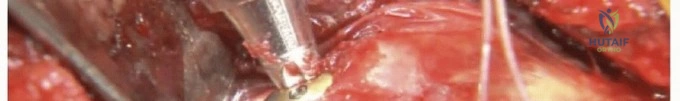 ABOS Part I Comprehensive Orthopaedic Review: Knee, Hip & Femur Trauma, Acetabular Reconstruction | Part 21543