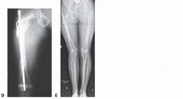 Illustration 4 for Less Pain, More Function: Fassier-Duval Nailing for Osteogenesis Imperfecta