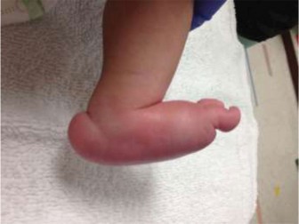 Rocker Bottom Foot: Accurate Diagnosis of Congenital Vertical Talus