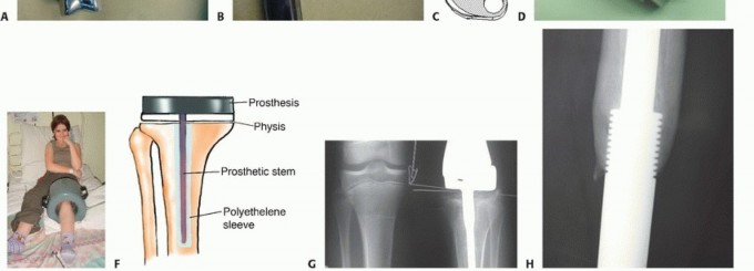 Illustration 5 for Expandable Prostheses: Understanding Infection Risk for Young Patients