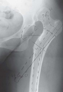 Illustration 11 for Successful Total Hip Replacement in Developmental Dysplasia