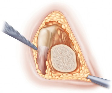 Illustration 7 for Minimally Invasive THA: Navigating Techniques, Benefits & Pitfalls