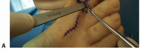 Illustration 30 for Hammer Toe Correction: Understanding the Extensor Digitorum Longus