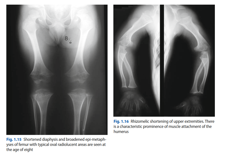 Illustration 4 for Orthopedic Cases Achondroplasia: Essential Insights & Management