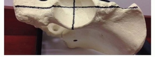 Illustration 11 for Total Hip Arthroplasty: Journey to Preventing Complications