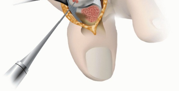 Illustration 10 for Mastering Extensive Plantar Release for Hallux Rigidus