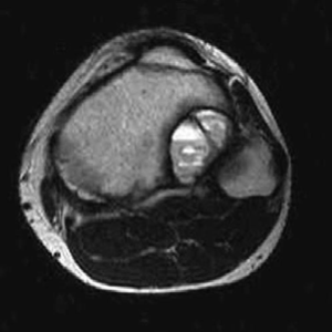 Aneurysmal Bone Cyst: Ace Your Oncology Structured Oral Exam