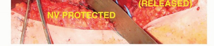 Illustration 33 for Limb-Sparing Resections Around the Shoulder: Optimizing Outcomes