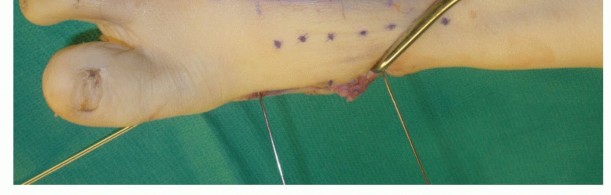 Illustration 48 for Mastering Midfoot Arthrodesis: Protect the Deep Neurovascular Bundle