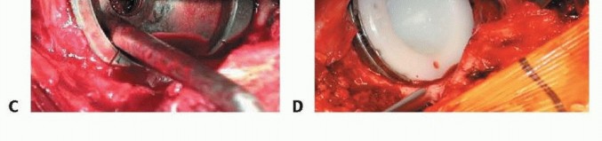 صورة طبية: استبدال مفصل الورك بدون أسمنت: استعادة الحركة والثبات في صنعاء مع الأستاذ الدكتور محمد هطيف